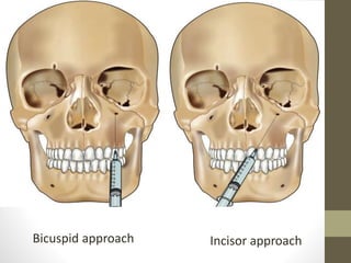 Bicuspid approach Incisor approach
 