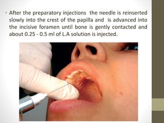 • After the preparatory injections the needle is reinserted
slowly into the crest of the papilla and is advanced into
the incisive foramen until bone is gently contacted and
about 0.25 - 0.5 ml of L.A solution is injected.
 