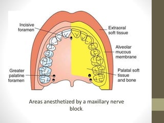 Areas anesthetized by a maxillary nerve
block.
 