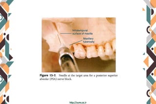 Maxillary anesthesia techniques | PDF