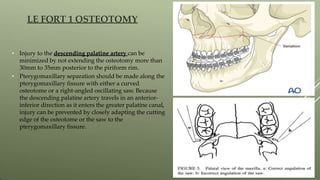 • Injury to the descending palatine artery can be
minimized by not extending the osteotomy more than
30mm to 35mm posterior to the piriform rim.
• Pterygomaxillary separation should be made along the
pterygomaxillary fissure with either a curved
osteotome or a right-angled oscillating saw. Because
the descending palatine artery travels in an anterior-
inferior direction as it enters the greater palatine canal,
injury can be prevented by closely adapting the cutting
edge of the osteotome or the saw to the
pterygomaxillary fissure.
LE FORT 1 OSTEOTOMY
 