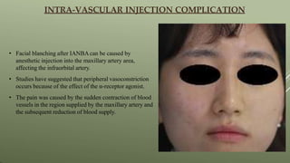 • Facial blanching after IANBAcan be caused by
anesthetic injection into the maxillary artery area,
affecting the infraorbital artery.
• Studies have suggested that peripheral vasoconstriction
occurs because of the effect of the α-receptor agonist.
• The pain was caused by the sudden contraction of blood
vessels in the region supplied by the maxillary artery and
the subsequent reduction of blood supply.
INTRA-VASCULAR INJECTION COMPLICATION
 