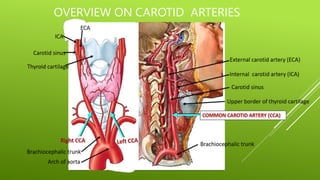 OVERVIEW ON CAROTID ARTERIES
 
