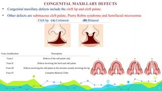 Maxillary Defects Classification MAXILLARY DEFECTS CLASSIFICATIONS & DIFFERENT PROSTHETIC ...