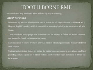 They consists of only bands and wires without any acrylic covering.
1)HYRAX EXPANDER:
• Introduced by William Biederman in 1968.It makes use of a special screw called HYRAX (
Hygenic Rapid Expander),which is essentially a nonspring loaded jackscrew with an all wire
frame.
• The screws have heavy gauge wire extensions that are adapted to follow the palatal contours
and soldered to bands on premolar and molar.
• Each activation of screw produces approx.0.2mm of lateral expansion and it is activated from
front to back.
• Main advantage is that it does not irritate the palatal mucosa; is easy to keep clean; capable of
providing sutural separation of 11mm within a short period of wear; maximum of 13mm can
be achieved.
 