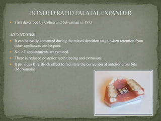  First described by Cohen and Silverman in 1973
ADVANTAGES:
 It can be easily cemented during the mixed dentition stage, when retention from
other appliances can be poor.
 No. of appointments are reduced.
 There is reduced posterior teeth tipping and extrusion.
 It provides Bite Block effect to facilitate the correction of anterior cross bite
(McNamara)
 