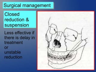 Surgical management
Closed
reduction &
suspension
Less effective if
there is delay in
treatment
or
unstable
reduction
 