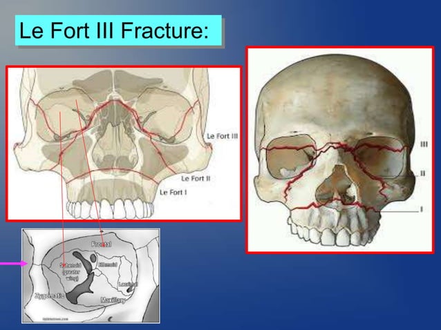 Mid face fracture-Maxillary fracture | PPT