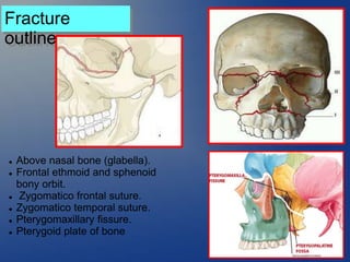  Above nasal bone (glabella).
 Frontal ethmoid and sphenoid
bony orbit.
 Zygomatico frontal suture.
 Zygomatico temporal suture.
 Pterygomaxillary fissure.
 Pterygoid plate of bone
Fracture
outline
 