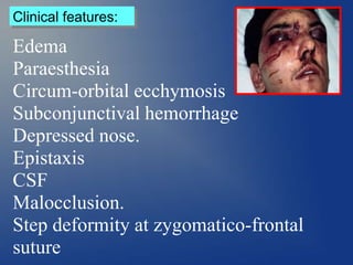 Clinical features:
Edema
Paraesthesia
Circum-orbital ecchymosis
Subconjunctival hemorrhage
Depressed nose.
Epistaxis
CSF
Malocclusion.
Step deformity at zygomatico-frontal
suture
 