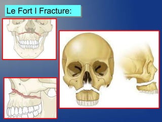 Le Fort I Fracture:
 
