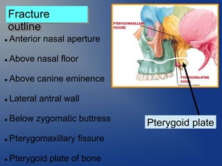 Fracture
outline
Pterygoid plate
 Anterior nasal aperture
 Above nasal floor
 Above canine eminence
 Lateral antral wall
 Below zygomatic buttress
 Pterygomaxillary fissure
 Pterygoid plate of bone
 