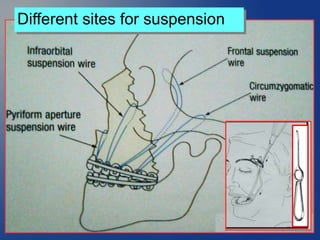 Different sites for suspension
 