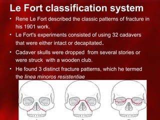 Fort Classification Maxillary fractures ih | PPT