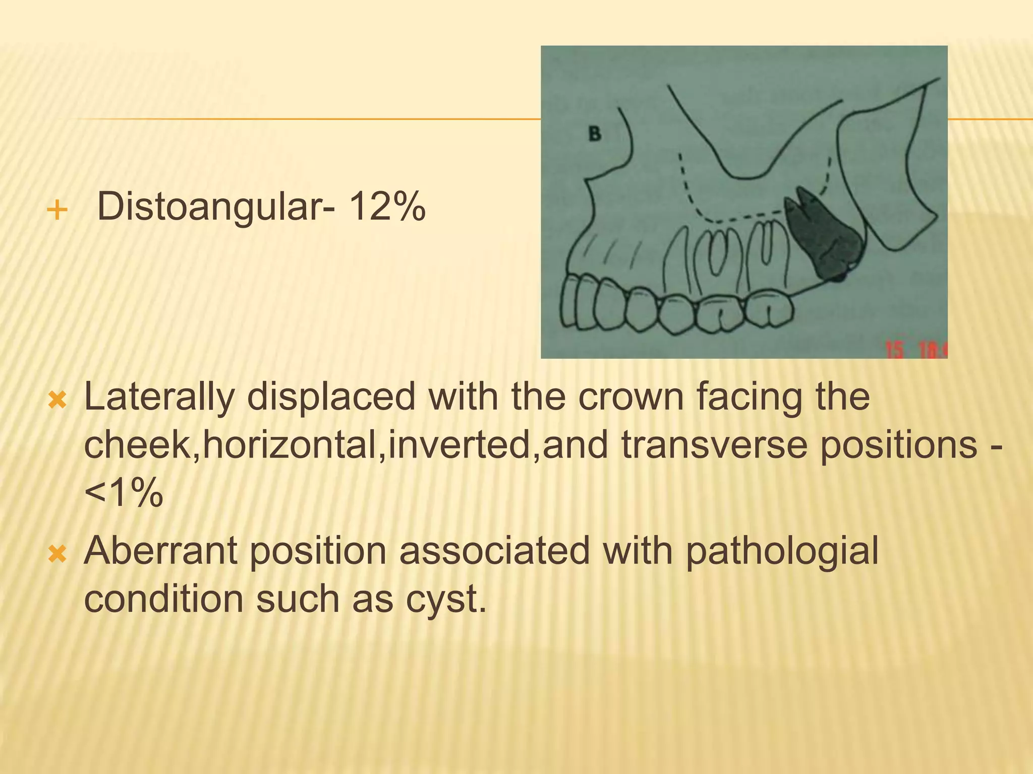 Maxillary impactions | PPTX