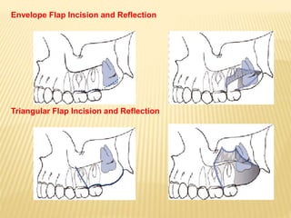 Maxillary impactions | PPTX