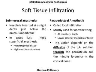 Maxillay Infiltration Anesthetic Techniques
Hesham El-Hawary
Soft Tissue Infiltration
Submucosal anesthesia
 Needle is in...