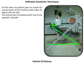 Maxillay Infiltration Anesthetic Techniques
Hesham El-Hawary
So that when the patient
open his mouth the occlusal
plane of...
