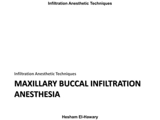Maxillay Infiltration Anesthetic Techniques
Hesham El-Hawary
MAXILLARY BUCCAL INFILTRATION
ANESTHESIA
Infiltration Anesthe...