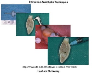 Maxillay Infiltration Anesthetic Techniques
Hesham El-Hawary
http://www.cda-adc.ca/jcda/vol-67/issue-7/391.html
 