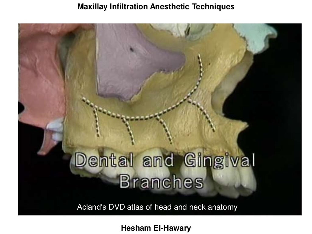 Maxillary infiltration anesthetic techniques (with photos)