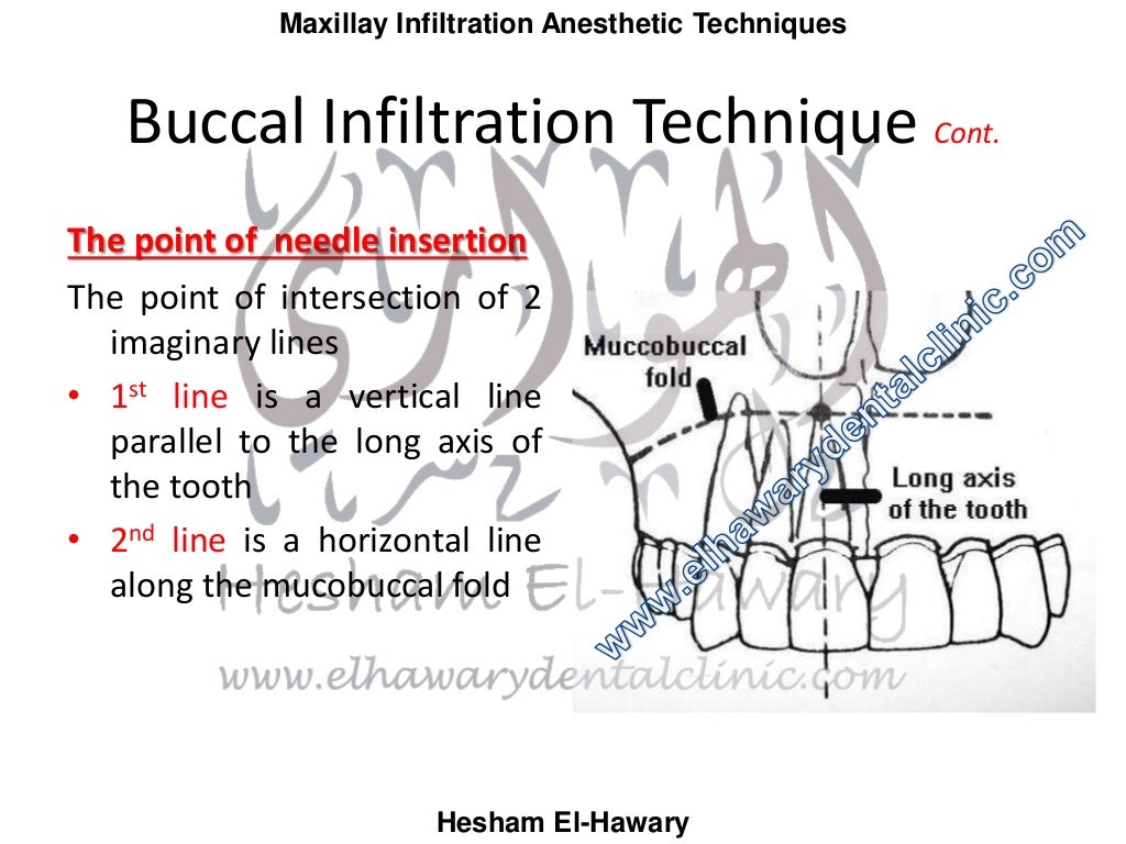 Maxillary infiltration anesthetic techniques (with photos)