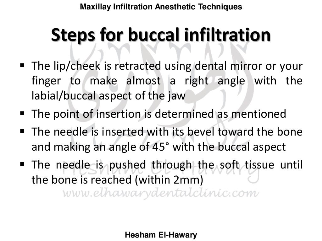 Maxillary infiltration anesthetic techniques (with photos)