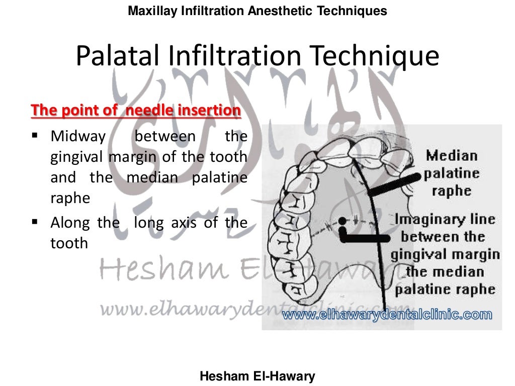 Dental Anesthesia Maxillary Infiltration Technique Ne vrogue.co