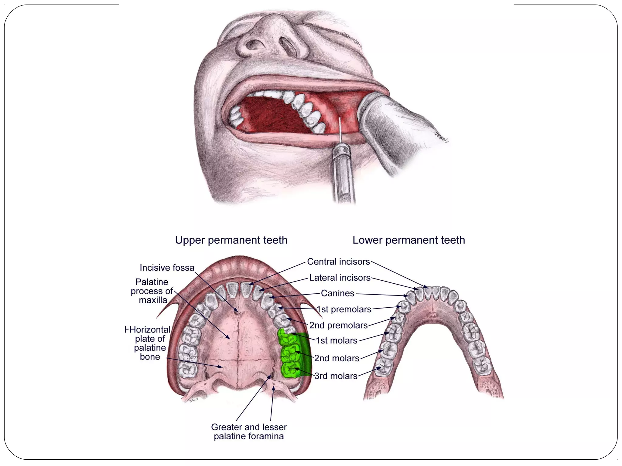 Max Injection Technique Maxillary injection techniques | PPT