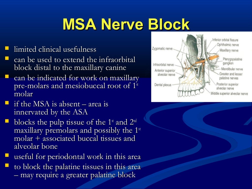 Maxillary Local Anesthesia