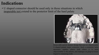 Indications
• U shaped connector should be used only in those situations in which
inoperable tori extend to the posterior limit of the hard palate
Removable partial denture design that uses an objectionable
U-shaped palatal major connector. Such a connector lacks
necessary rigidity, places bulk where it is most
objectionable to the patient, and impinges on gingival tissue
lingual to remaining teeth
 
