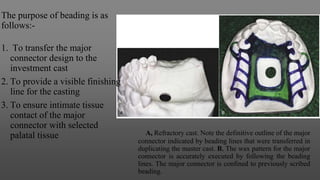A, Refractory cast. Note the definitive outline of the major
connector indicated by beading lines that were transferred in
duplicating the master cast. B, The wax pattern for the major
connector is accurately executed by following the beading
lines. The major connector is confined to previously scribed
beading.
The purpose of beading is as
follows:-
1. To transfer the major
connector design to the
investment cast
2. To provide a visible finishing
line for the casting
3. To ensure intimate tissue
contact of the major
connector with selected
palatal tissue
 