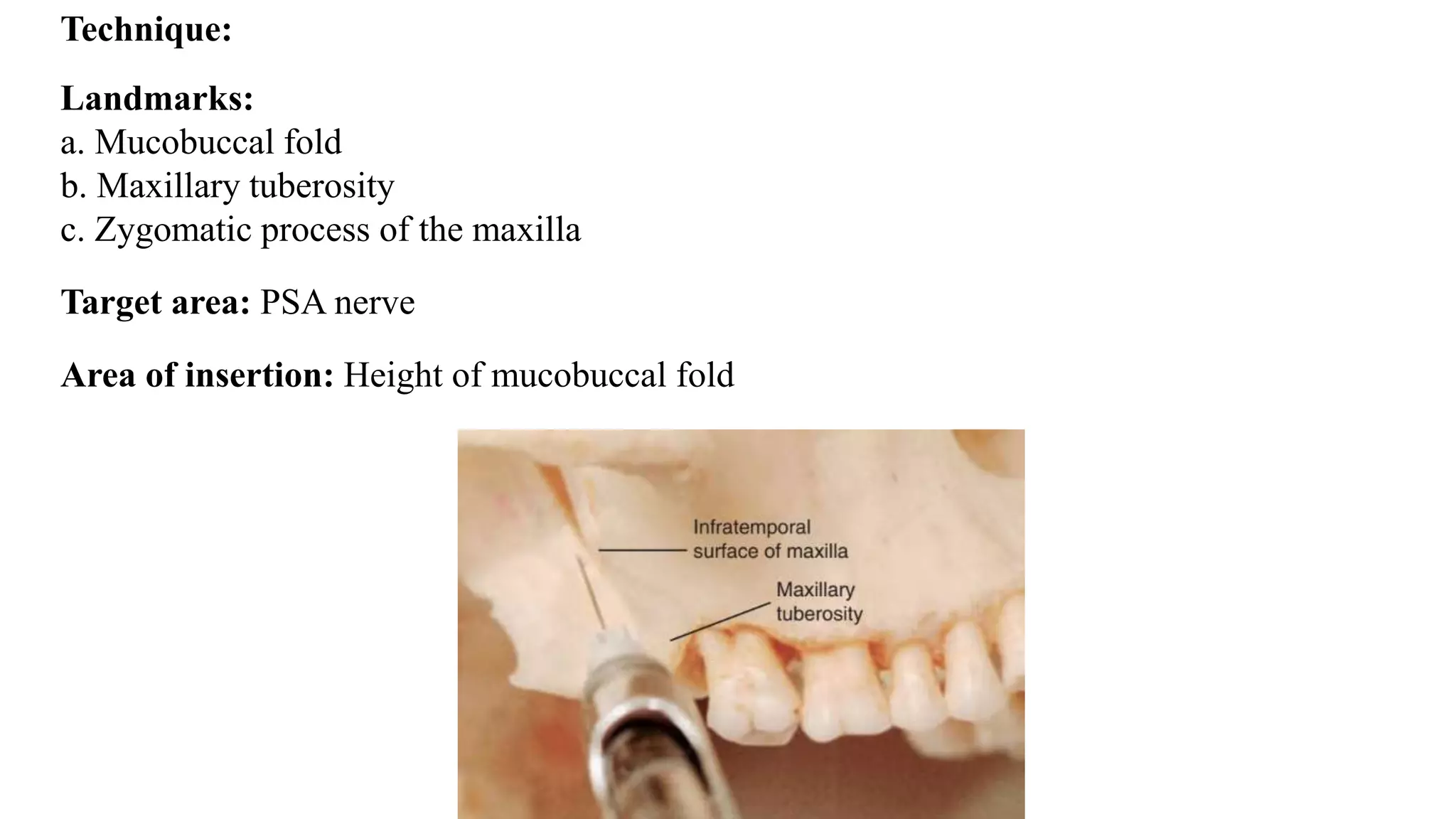 Technique:
Landmarks:
a. Mucobuccal fold
b. Maxillary tuberosity
c. Zygomatic process of the maxilla
Target area: PSA nerve
Area of insertion: Height of mucobuccal fold
 