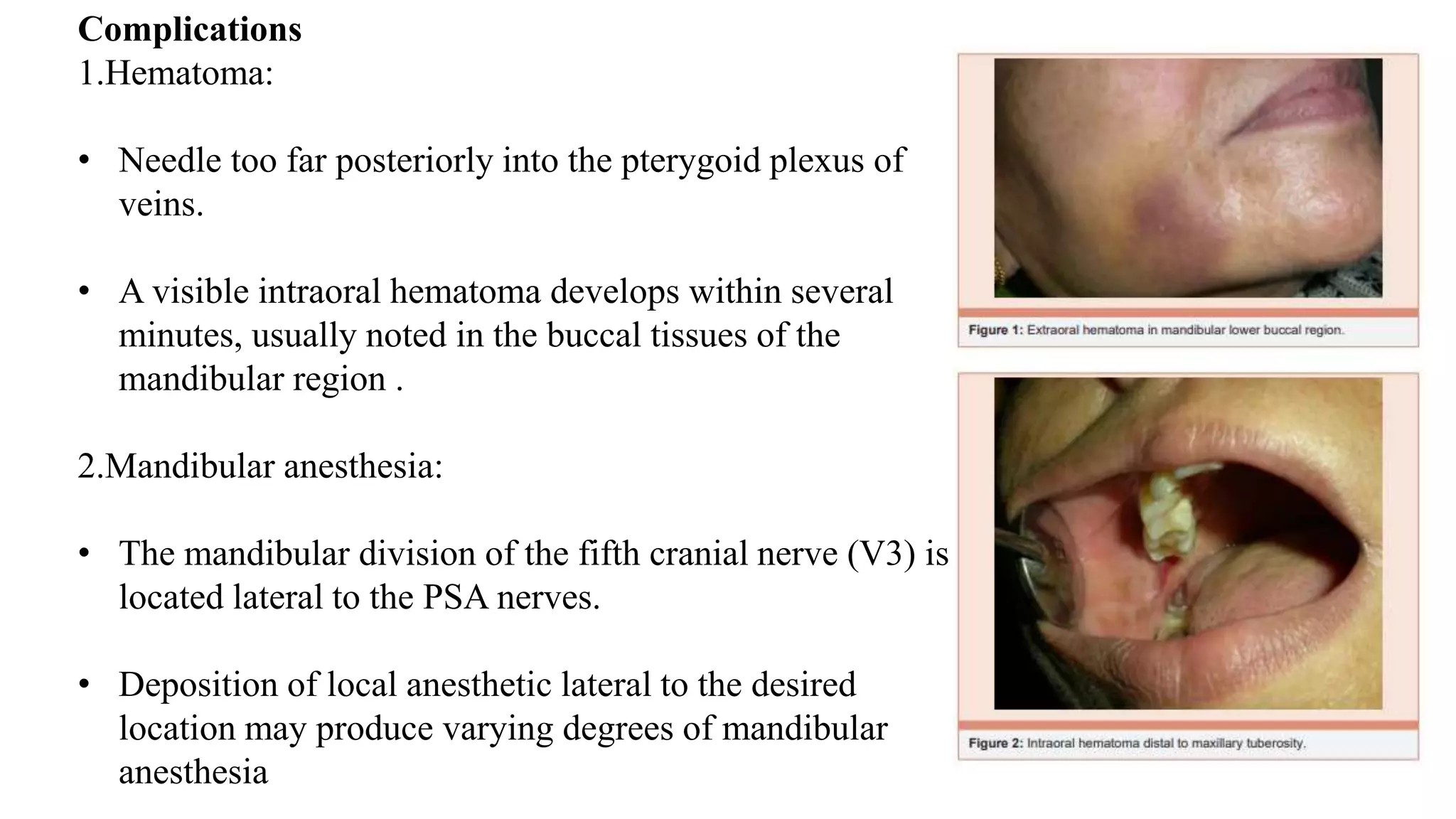 Complications
1.Hematoma:
• Needle too far posteriorly into the pterygoid plexus of
veins.
• A visible intraoral hematoma develops within several
minutes, usually noted in the buccal tissues of the
mandibular region .
2.Mandibular anesthesia:
• The mandibular division of the fifth cranial nerve (V3) is
located lateral to the PSA nerves.
• Deposition of local anesthetic lateral to the desired
location may produce varying degrees of mandibular
anesthesia
 