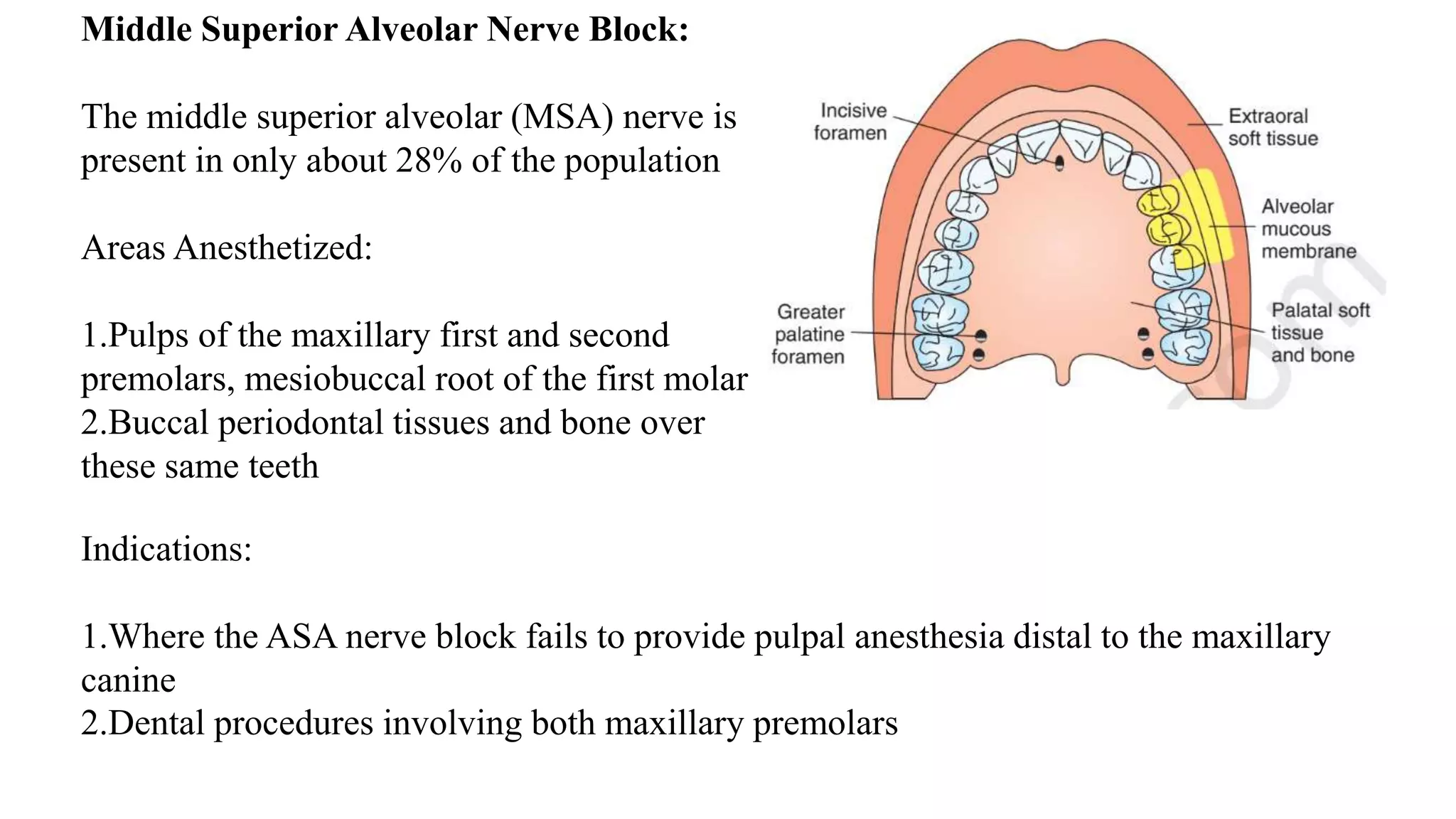 Middle Superior Alveolar Nerve Block:
The middle superior alveolar (MSA) nerve is
present in only about 28% of the population
Areas Anesthetized:
1.Pulps of the maxillary first and second
premolars, mesiobuccal root of the first molar
2.Buccal periodontal tissues and bone over
these same teeth
Indications:
1.Where the ASA nerve block fails to provide pulpal anesthesia distal to the maxillary
canine
2.Dental procedures involving both maxillary premolars
 