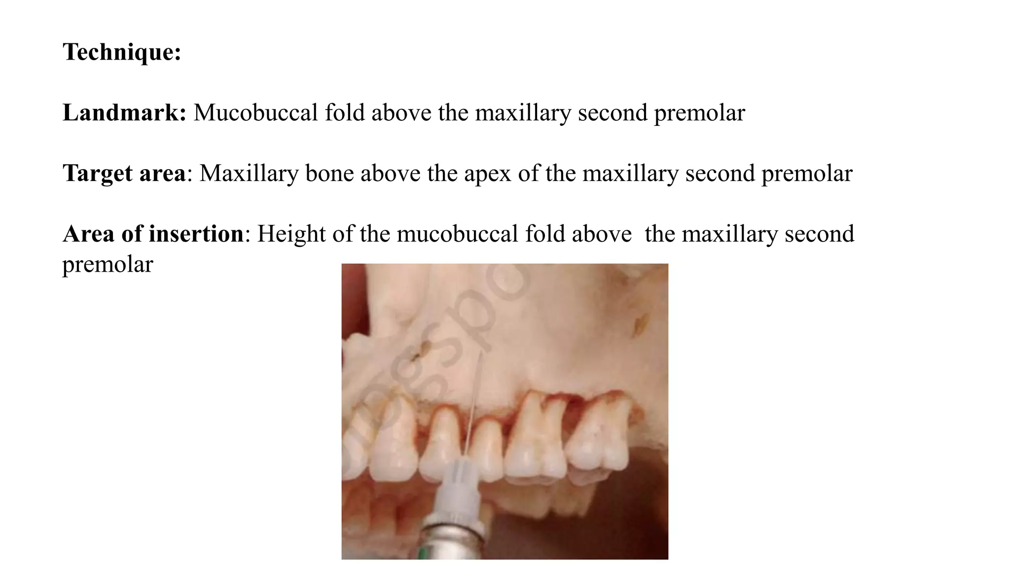 Technique:
Landmark: Mucobuccal fold above the maxillary second premolar
Target area: Maxillary bone above the apex of the maxillary second premolar
Area of insertion: Height of the mucobuccal fold above the maxillary second
premolar
 