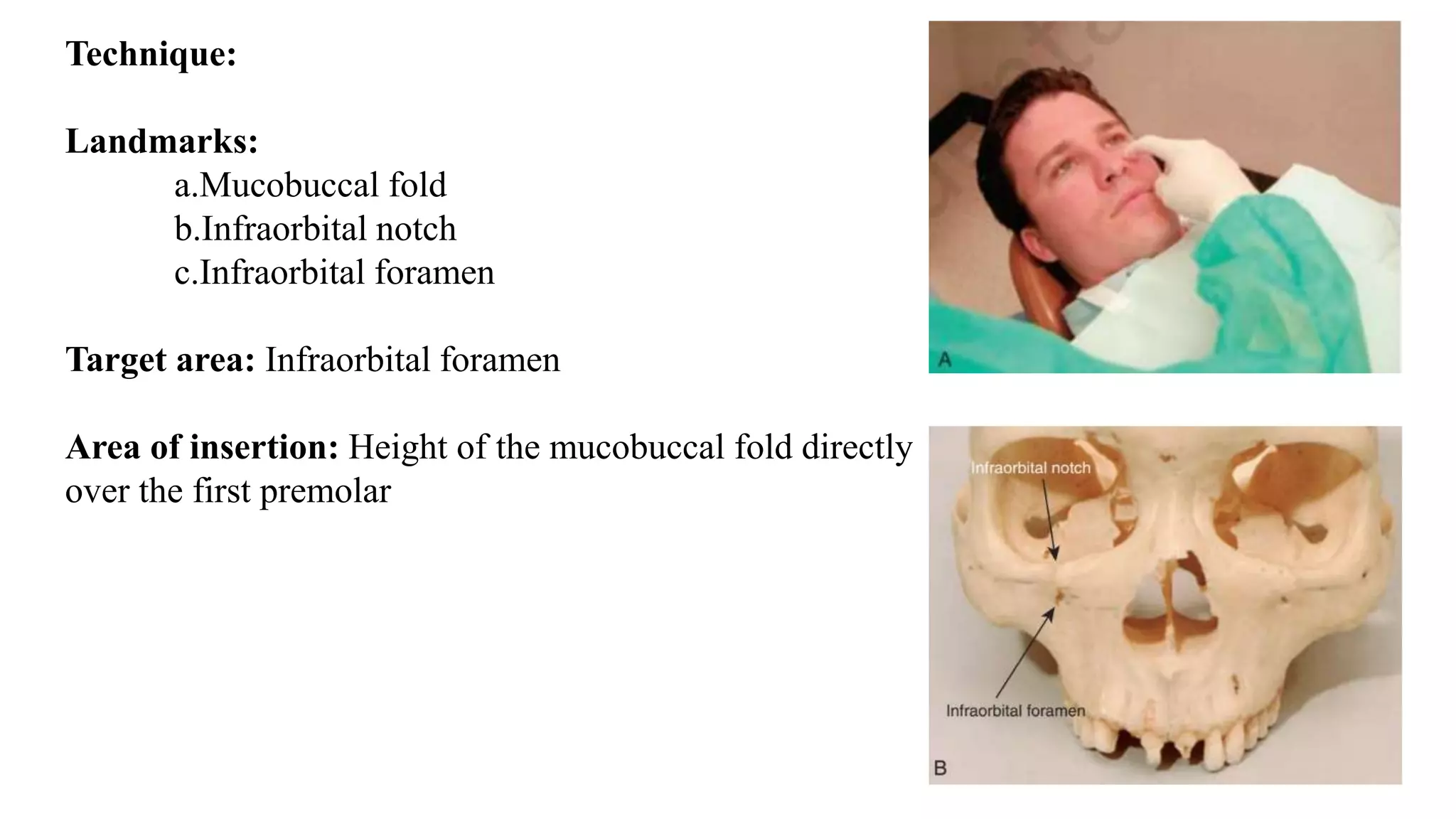 Technique:
Landmarks:
a.Mucobuccal fold
b.Infraorbital notch
c.Infraorbital foramen
Target area: Infraorbital foramen
Area of insertion: Height of the mucobuccal fold directly
over the first premolar
 