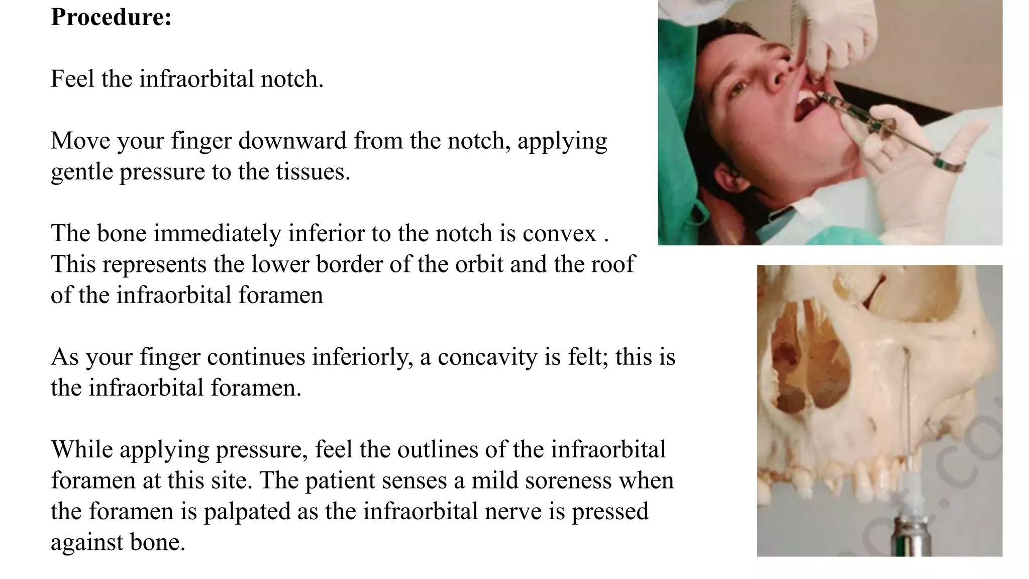 Procedure:
Feel the infraorbital notch.
Move your finger downward from the notch, applying
gentle pressure to the tissues.
The bone immediately inferior to the notch is convex .
This represents the lower border of the orbit and the roof
of the infraorbital foramen
As your finger continues inferiorly, a concavity is felt; this is
the infraorbital foramen.
While applying pressure, feel the outlines of the infraorbital
foramen at this site. The patient senses a mild soreness when
the foramen is palpated as the infraorbital nerve is pressed
against bone.
 