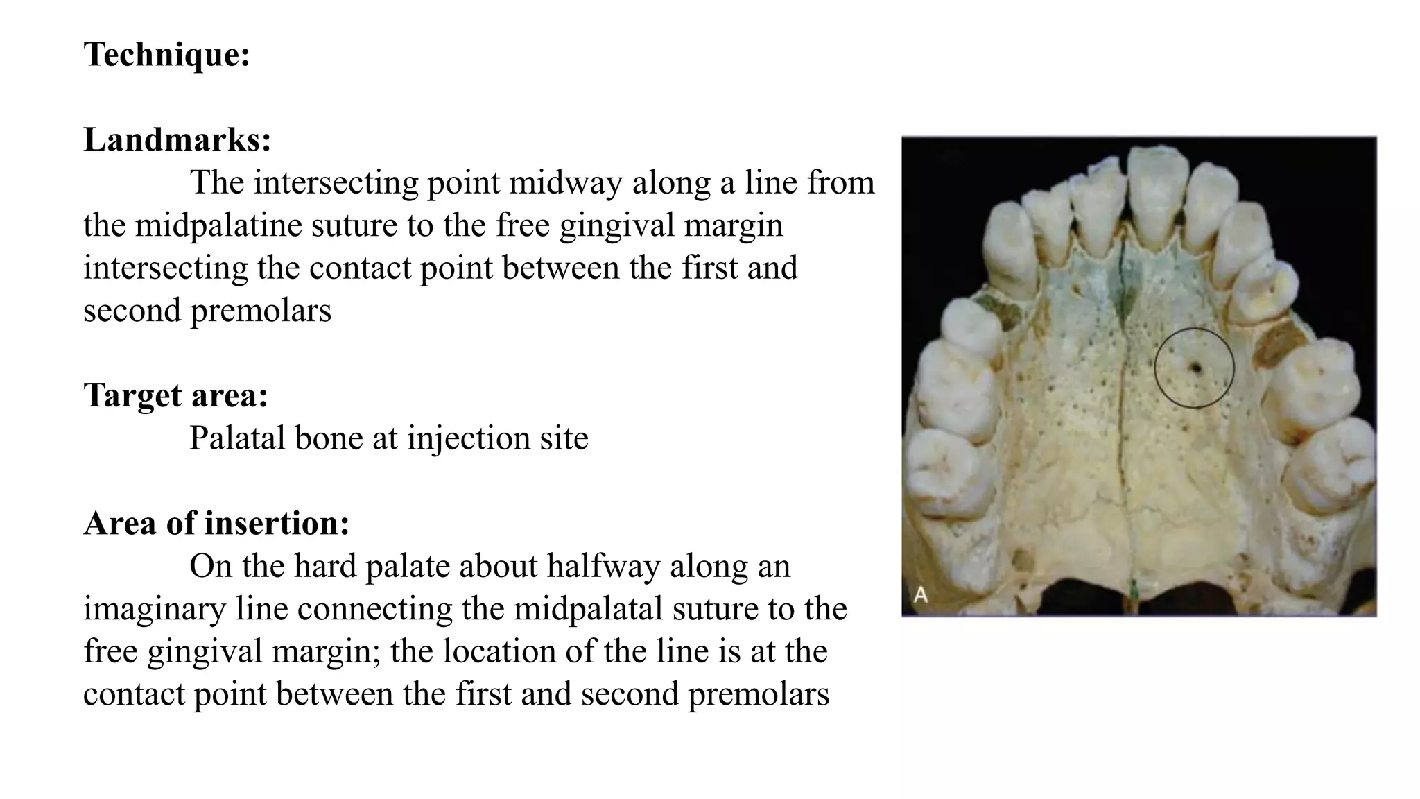 Technique:
Landmarks:
The intersecting point midway along a line from
the midpalatine suture to the free gingival margin
intersecting the contact point between the first and
second premolars
Target area:
Palatal bone at injection site
Area of insertion:
On the hard palate about halfway along an
imaginary line connecting the midpalatal suture to the
free gingival margin; the location of the line is at the
contact point between the first and second premolars
 
