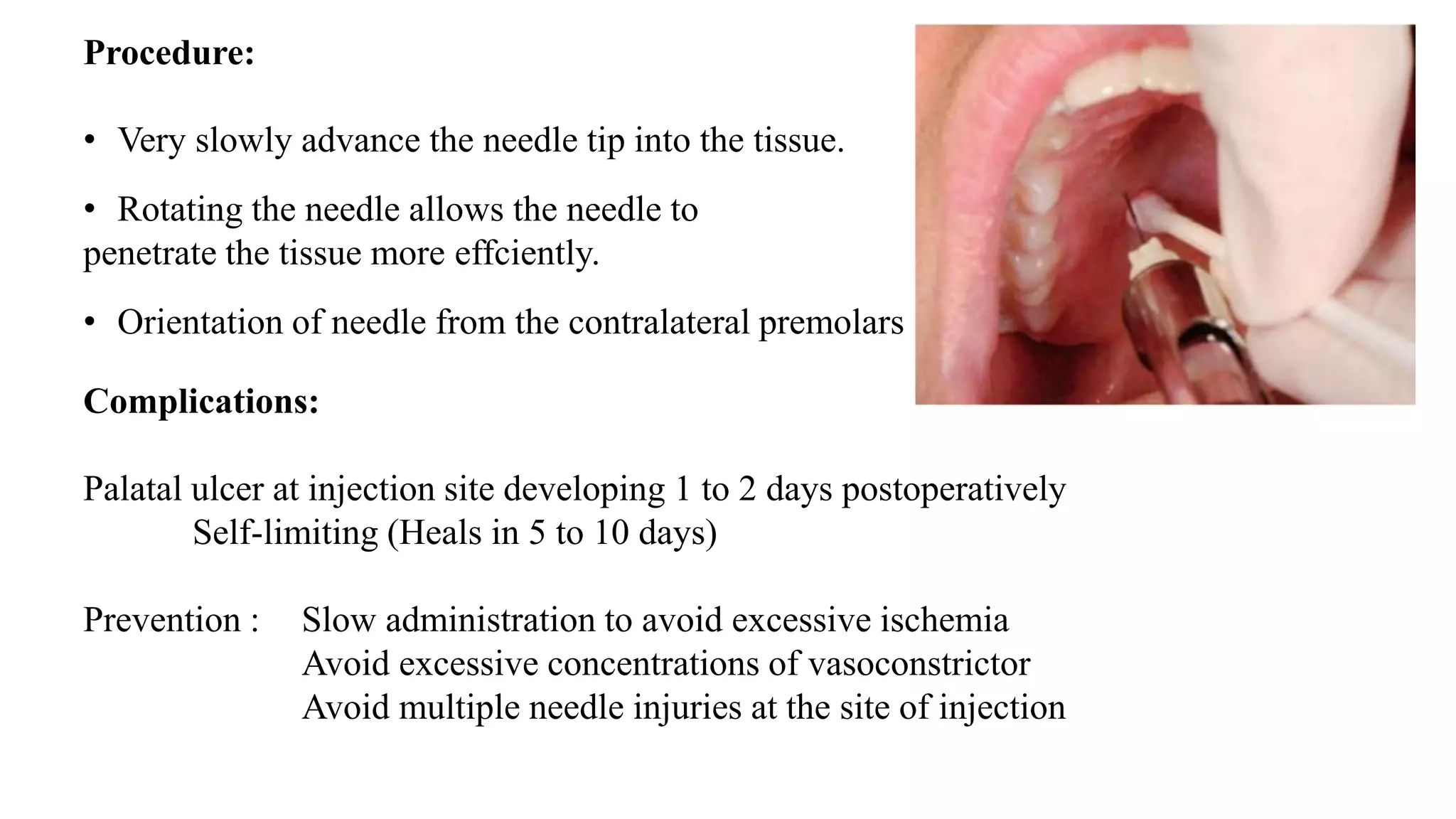 Procedure:
• Very slowly advance the needle tip into the tissue.
• Rotating the needle allows the needle to
penetrate the tissue more effciently.
• Orientation of needle from the contralateral premolars
Complications:
Palatal ulcer at injection site developing 1 to 2 days postoperatively
Self-limiting (Heals in 5 to 10 days)
Prevention : Slow administration to avoid excessive ischemia
Avoid excessive concentrations of vasoconstrictor
Avoid multiple needle injuries at the site of injection
 