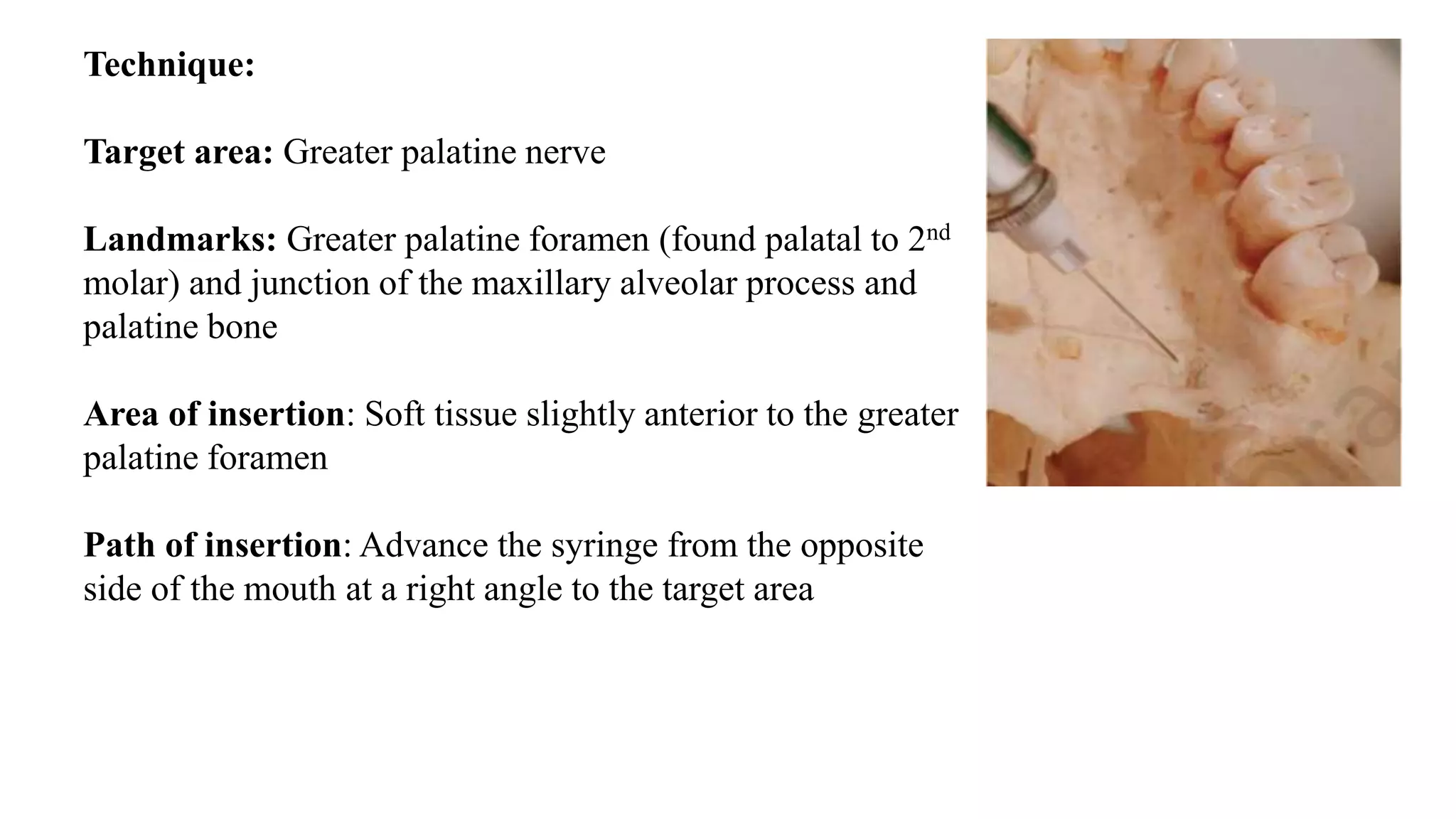Technique:
Target area: Greater palatine nerve
Landmarks: Greater palatine foramen (found palatal to 2nd
molar) and junction of the maxillary alveolar process and
palatine bone
Area of insertion: Soft tissue slightly anterior to the greater
palatine foramen
Path of insertion: Advance the syringe from the opposite
side of the mouth at a right angle to the target area
 