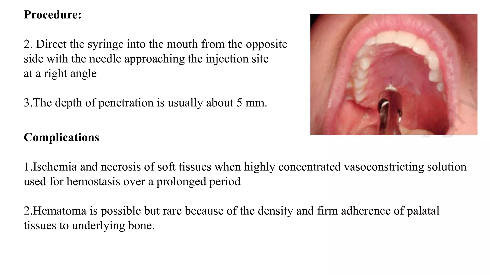 Procedure:
2. Direct the syringe into the mouth from the opposite
side with the needle approaching the injection site
at a right angle
3.The depth of penetration is usually about 5 mm.
Complications
1.Ischemia and necrosis of soft tissues when highly concentrated vasoconstricting solution
used for hemostasis over a prolonged period
2.Hematoma is possible but rare because of the density and firm adherence of palatal
tissues to underlying bone.
 
