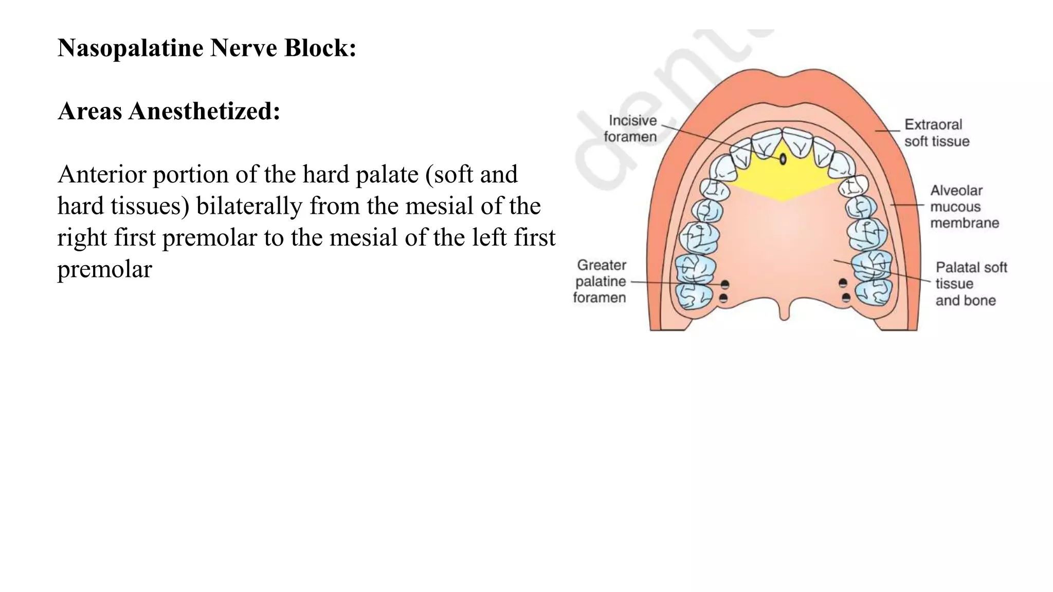 Nasopalatine Nerve Block:
Areas Anesthetized:
Anterior portion of the hard palate (soft and
hard tissues) bilaterally from the mesial of the
right first premolar to the mesial of the left first
premolar
 