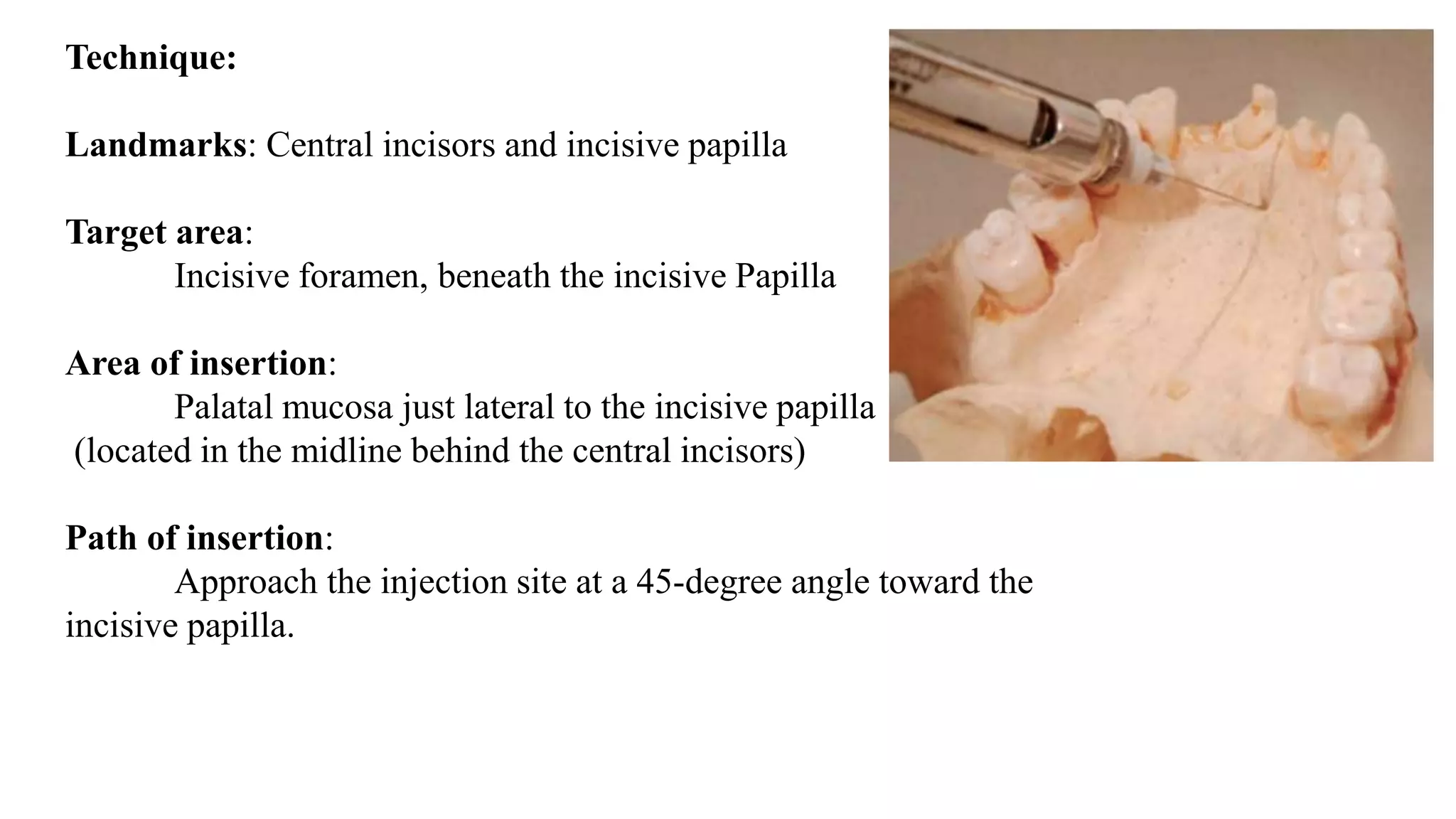 Technique:
Landmarks: Central incisors and incisive papilla
Target area:
Incisive foramen, beneath the incisive Papilla
Area of insertion:
Palatal mucosa just lateral to the incisive papilla
(located in the midline behind the central incisors)
Path of insertion:
Approach the injection site at a 45-degree angle toward the
incisive papilla.
 