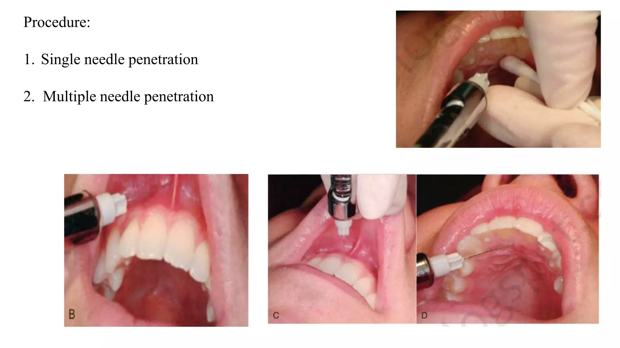 Procedure:
1. Single needle penetration
2. Multiple needle penetration
 