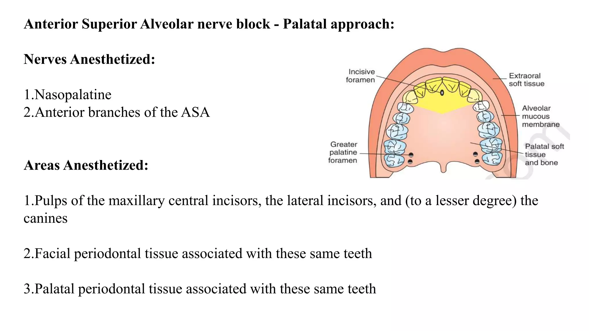 Anterior Superior Alveolar nerve block - Palatal approach:
Nerves Anesthetized:
1.Nasopalatine
2.Anterior branches of the ASA
Areas Anesthetized:
1.Pulps of the maxillary central incisors, the lateral incisors, and (to a lesser degree) the
canines
2.Facial periodontal tissue associated with these same teeth
3.Palatal periodontal tissue associated with these same teeth
 