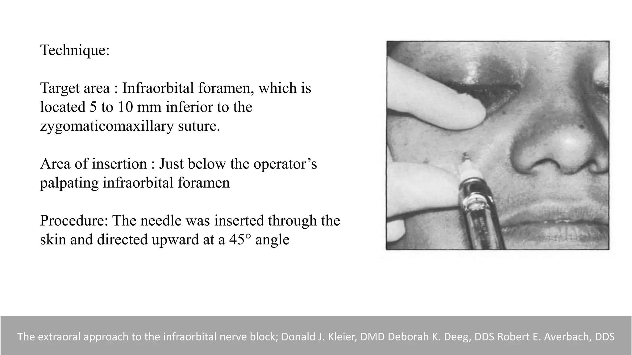 Technique:
Target area : Infraorbital foramen, which is
located 5 to 10 mm inferior to the
zygomaticomaxillary suture.
Area of insertion : Just below the operator’s
palpating infraorbital foramen
Procedure: The needle was inserted through the
skin and directed upward at a 45° angle
The extraoral approach to the infraorbital nerve block; Donald J. Kleier, DMD Deborah K. Deeg, DDS Robert E. Averbach, DDS
 