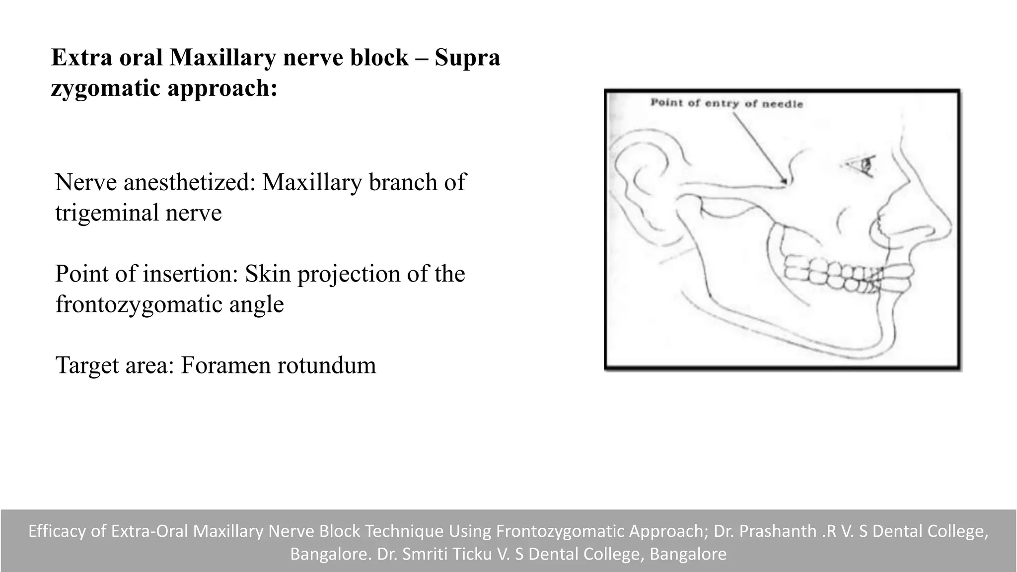 Efficacy of Extra-Oral Maxillary Nerve Block Technique Using Frontozygomatic Approach; Dr. Prashanth .R V. S Dental College,
Bangalore. Dr. Smriti Ticku V. S Dental College, Bangalore
Extra oral Maxillary nerve block – Supra
zygomatic approach:
Nerve anesthetized: Maxillary branch of
trigeminal nerve
Point of insertion: Skin projection of the
frontozygomatic angle
Target area: Foramen rotundum
 