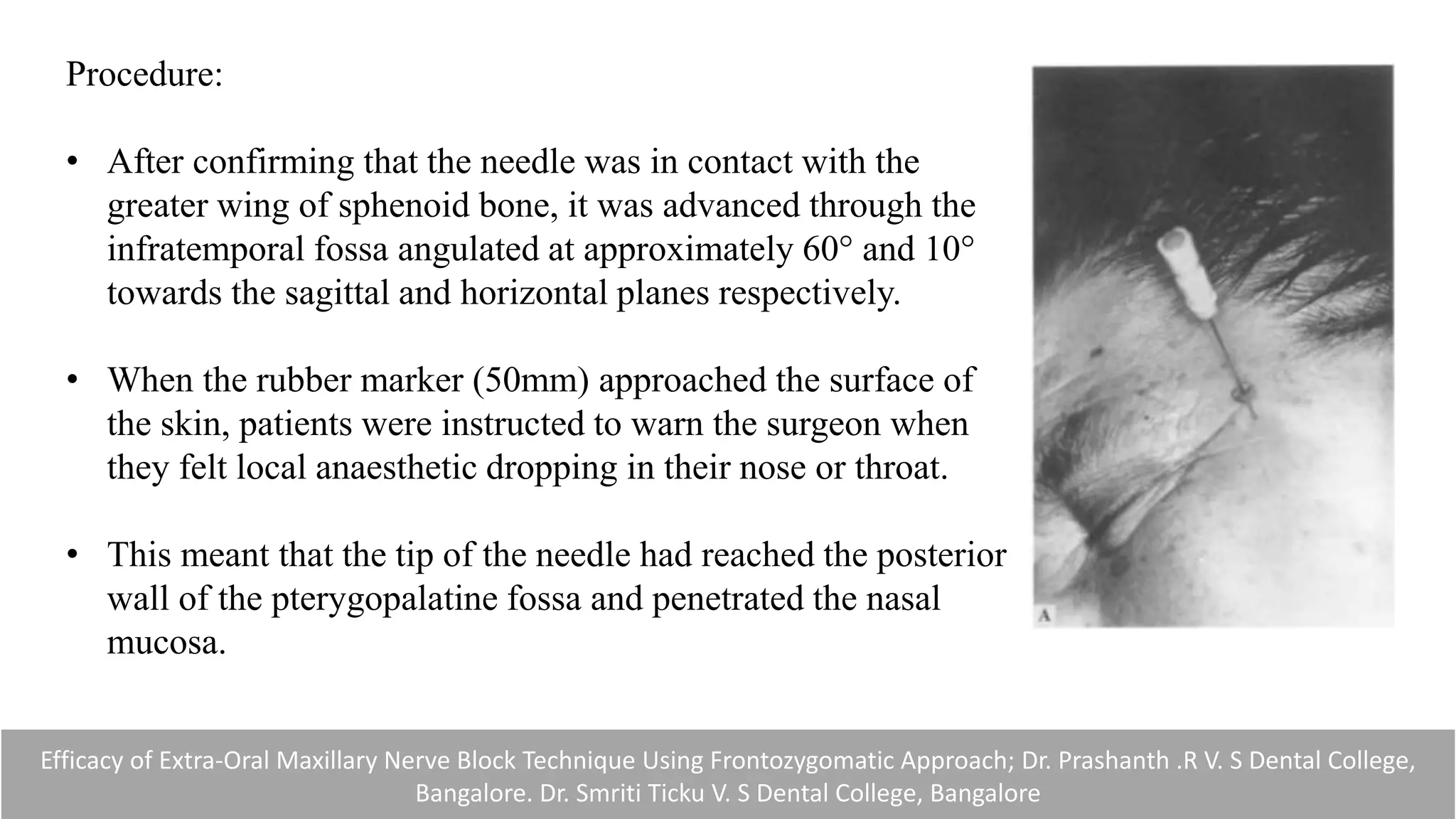 Procedure:
• After confirming that the needle was in contact with the
greater wing of sphenoid bone, it was advanced through the
infratemporal fossa angulated at approximately 60° and 10°
towards the sagittal and horizontal planes respectively.
• When the rubber marker (50mm) approached the surface of
the skin, patients were instructed to warn the surgeon when
they felt local anaesthetic dropping in their nose or throat.
• This meant that the tip of the needle had reached the posterior
wall of the pterygopalatine fossa and penetrated the nasal
mucosa.
Efficacy of Extra-Oral Maxillary Nerve Block Technique Using Frontozygomatic Approach; Dr. Prashanth .R V. S Dental College,
Bangalore. Dr. Smriti Ticku V. S Dental College, Bangalore
 