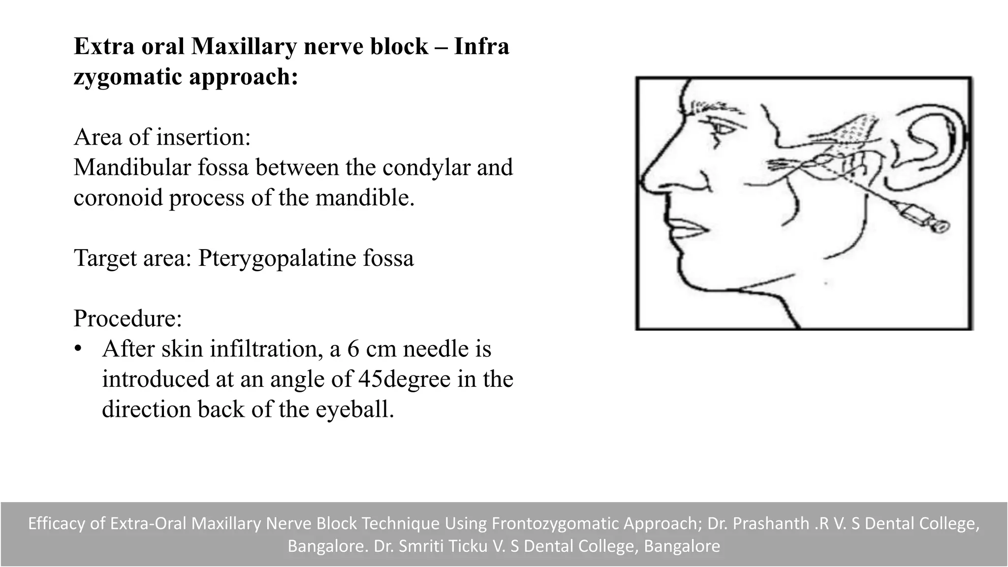 Efficacy of Extra-Oral Maxillary Nerve Block Technique Using Frontozygomatic Approach; Dr. Prashanth .R V. S Dental College,
Bangalore. Dr. Smriti Ticku V. S Dental College, Bangalore
Extra oral Maxillary nerve block – Infra
zygomatic approach:
Area of insertion:
Mandibular fossa between the condylar and
coronoid process of the mandible.
Target area: Pterygopalatine fossa
Procedure:
• After skin infiltration, a 6 cm needle is
introduced at an angle of 45degree in the
direction back of the eyeball.
 
